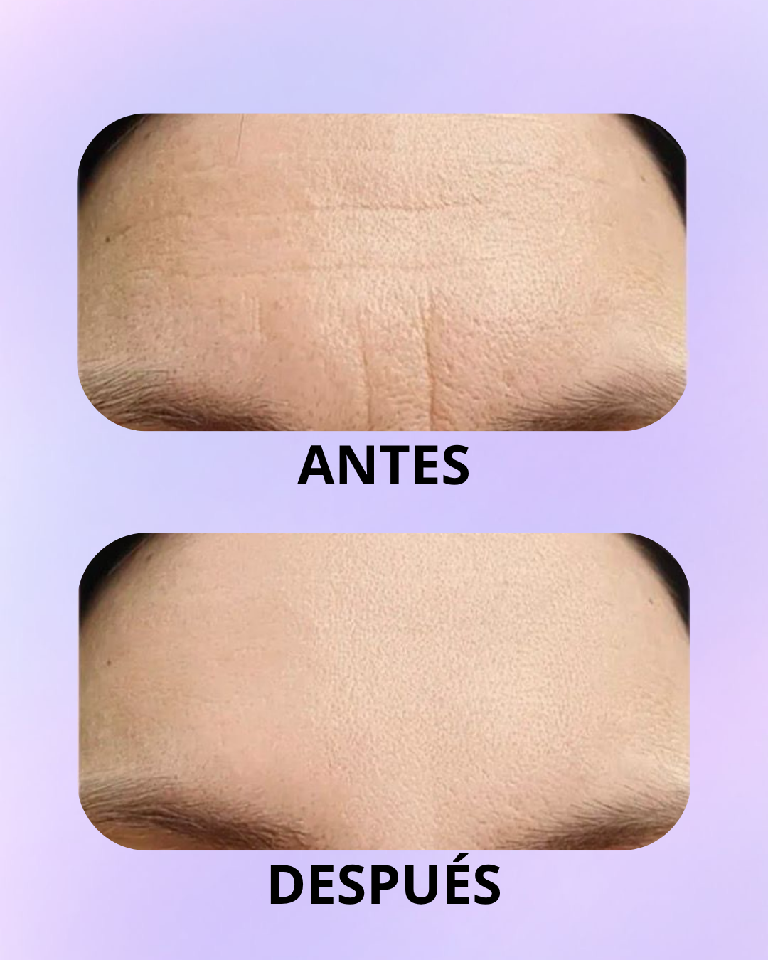 Parches Antiarrugas Frente