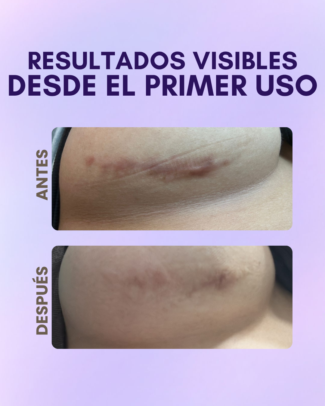 Parches de Silicona